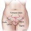 What is cervical cancer?